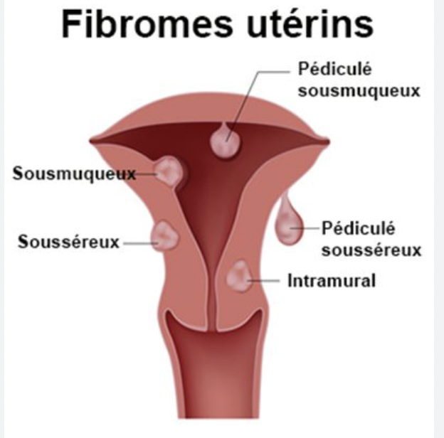 Le fibrome utérin, un fléau silencieux - Mousso