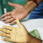 Les maladies du sang : l'anémie, un fléau sous-estimé - Mousso