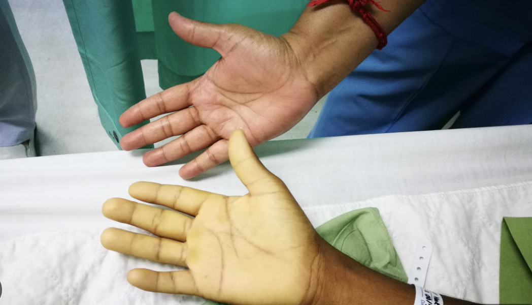 Les maladies du sang : l'anémie, un fléau sous-estimé - Mousso