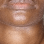 Goitre : la maladie des femmes stressées - Mousso