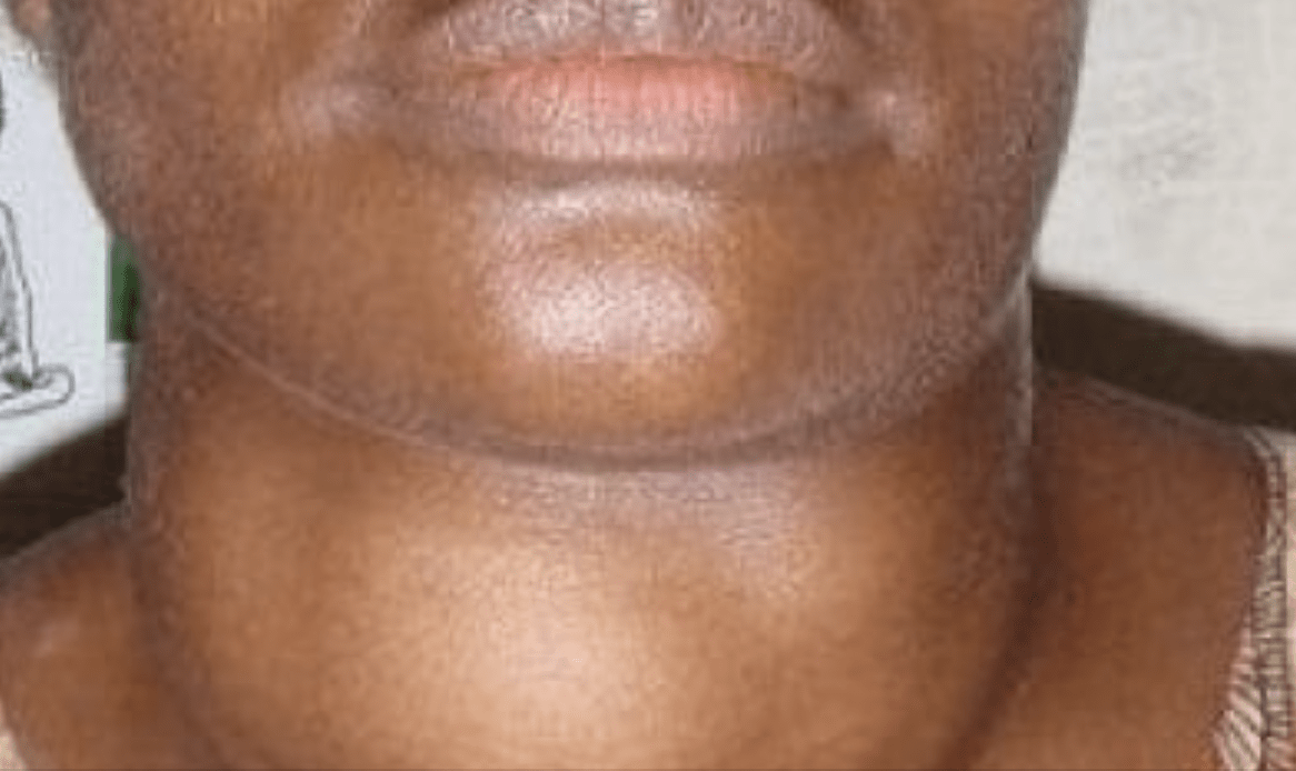 Goitre : la maladie des femmes stressées - Mousso