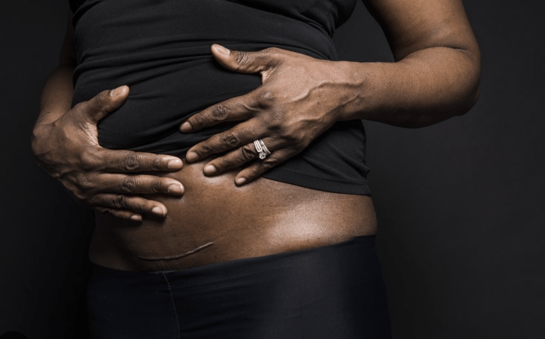 Négligences dans les maternités au Sénégal 5/6: opérée une semaine après ma césarienne dans l'ignorance - Mousso